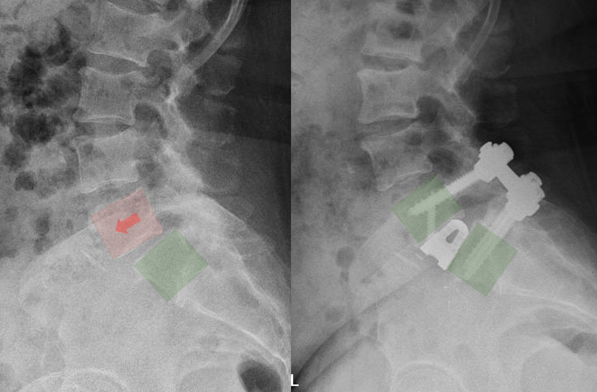 X-ray images of the lower spine showing a surgical procedure with hardware, such as screws and rods, implanted in the lumbar vertebrae.
