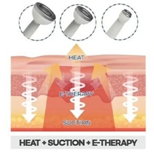 Diagram showing the use of a device for heat, suction, and e-therapy on the skin, with illustrations of the device in three stages.