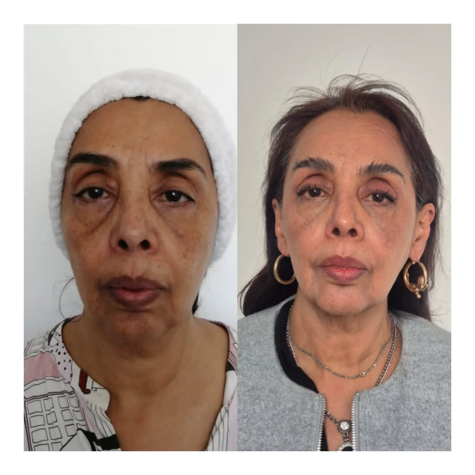 Endolaser facial