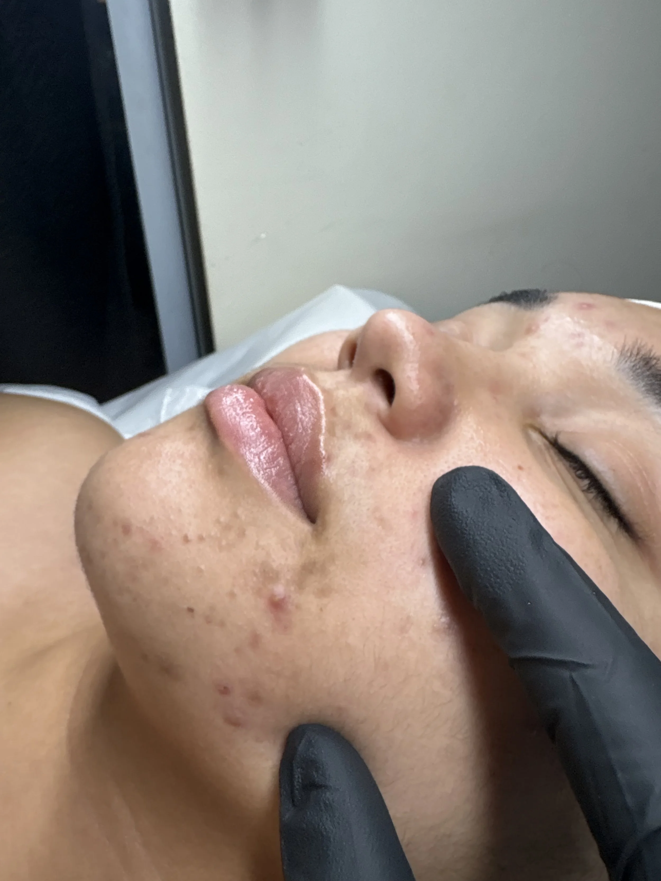 Clear Skin Boot Camp (In-Studio)