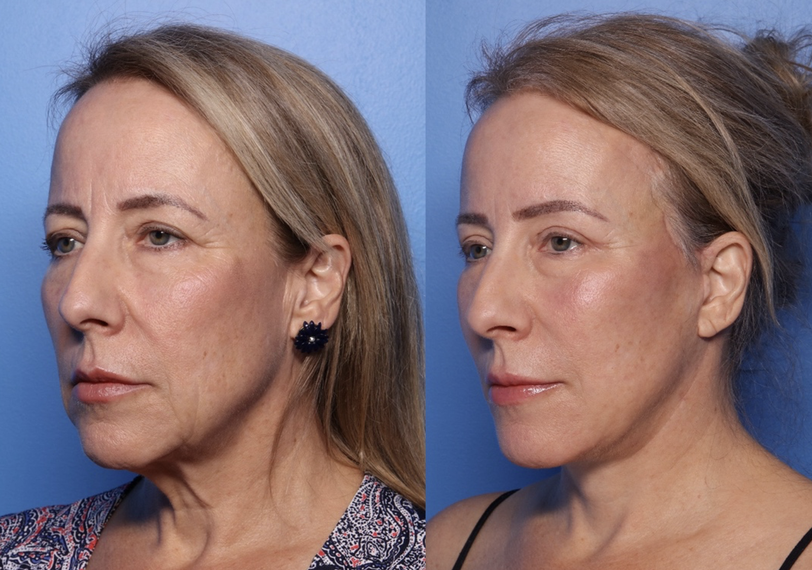 Side-by-side comparison of a middle-aged woman before and after a cosmetic procedure, showing facial improvements against a blue background.