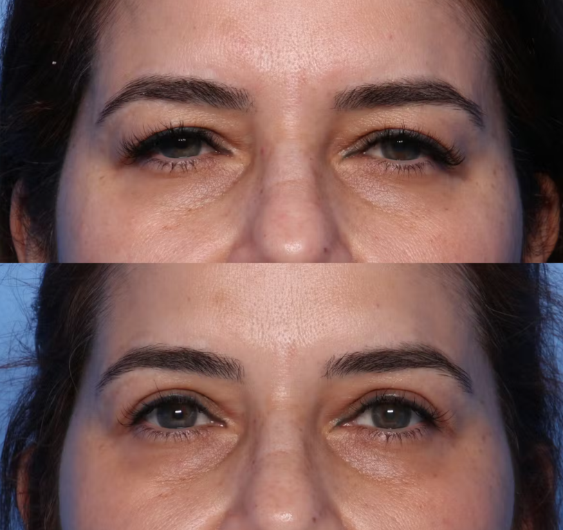Do I Need a Brow Lift or Upper Blepharoplasty?