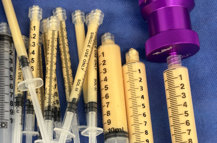 How Long Does Fat Grafting Last?