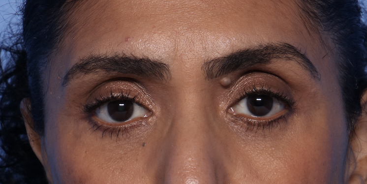 Can Filler Help With Hooded Eyes After Weight Loss?