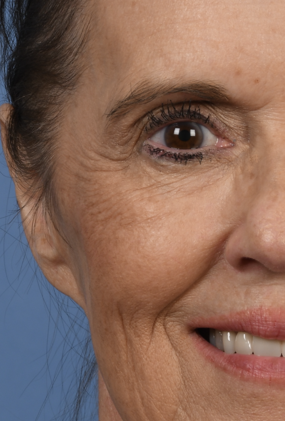 Why Are Some Wrinkles Dynamic and Why Do Some Become Permanent?