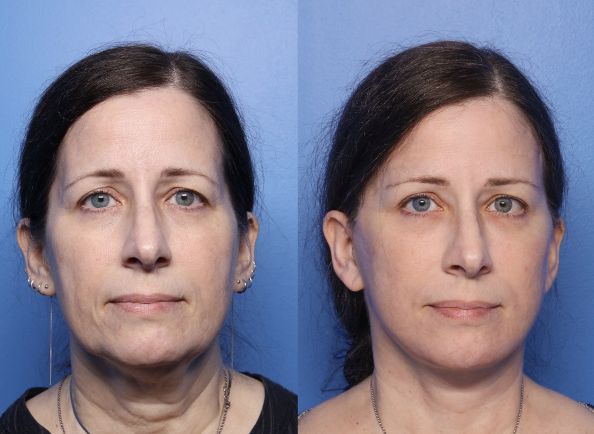 Comparison of a woman's face before and after cosmetic treatment, showing reduced wrinkles and improved skin appearance against a blue background.