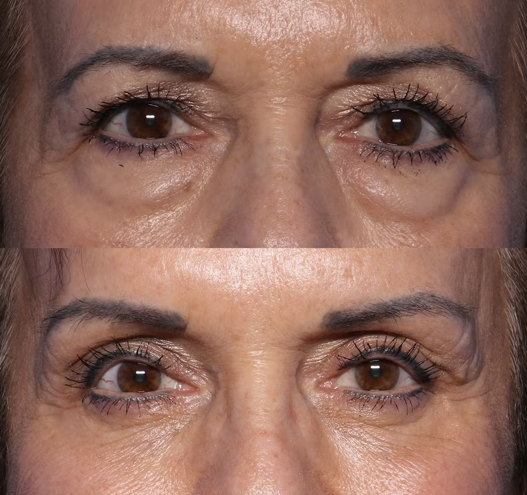 Close-up of a person's face focusing on their eyes, showing before and after images of eye area treatment, with noticeable reduction in wrinkles and skin tightening.