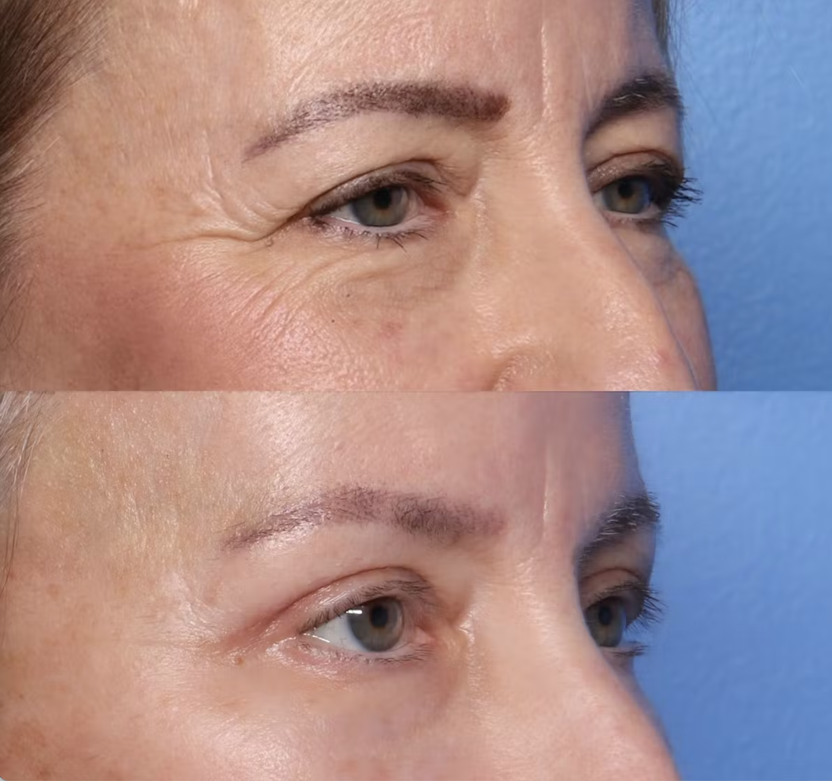 Close-up of a woman's face showing before and after images of a cosmetic procedure on her eyebrows, with the top image revealing well-defined eyebrows and the bottom showing sparse eyebrows.
