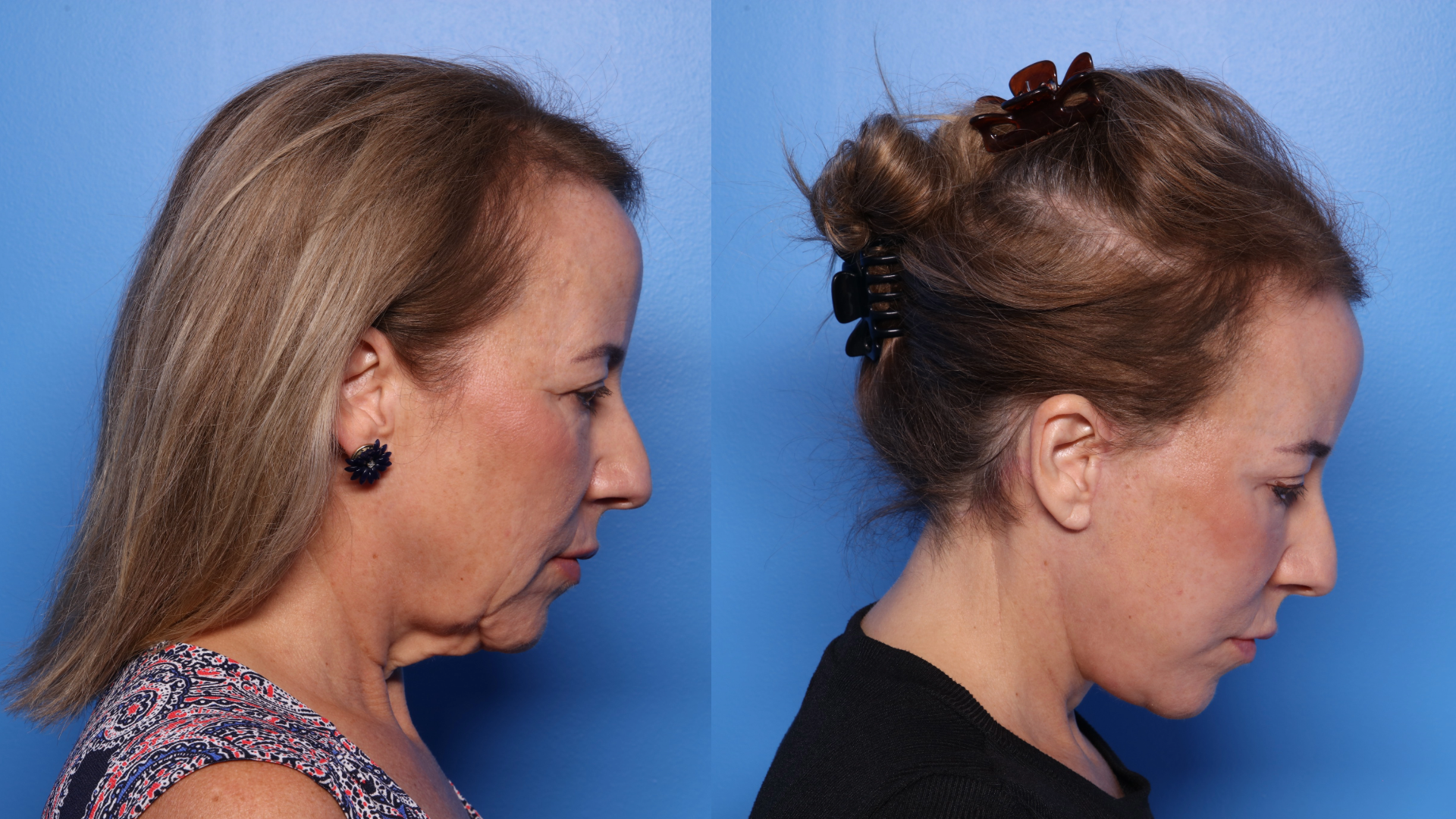 Comparison of two women in profile, one with long hair and the other with hair in rollers, against a blue background.