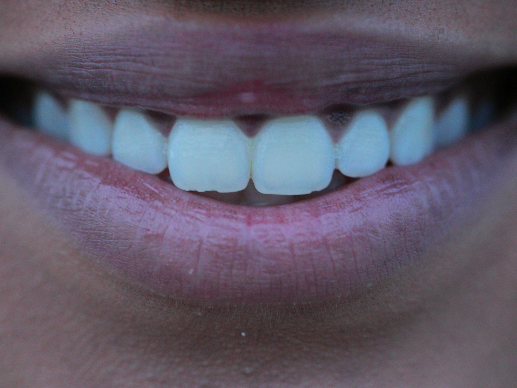 Close-up of a person's partly open mouth revealing their upper and lower teeth.