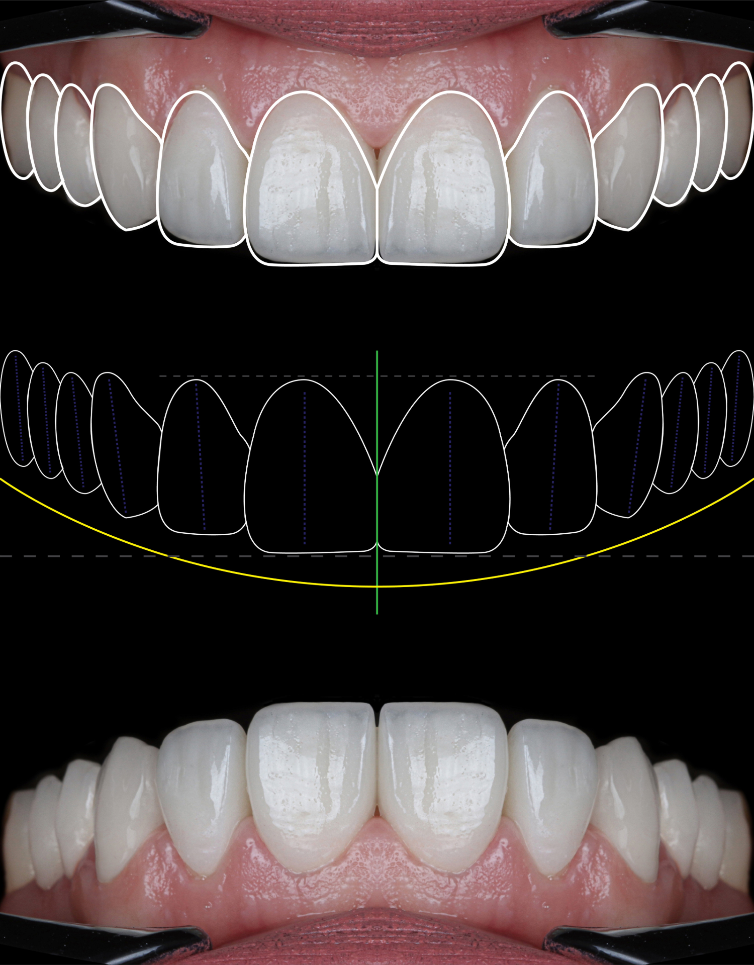 Close-up of a person's upper and lower teeth with dental outline overlay, showing a dental treatment or analysis process.