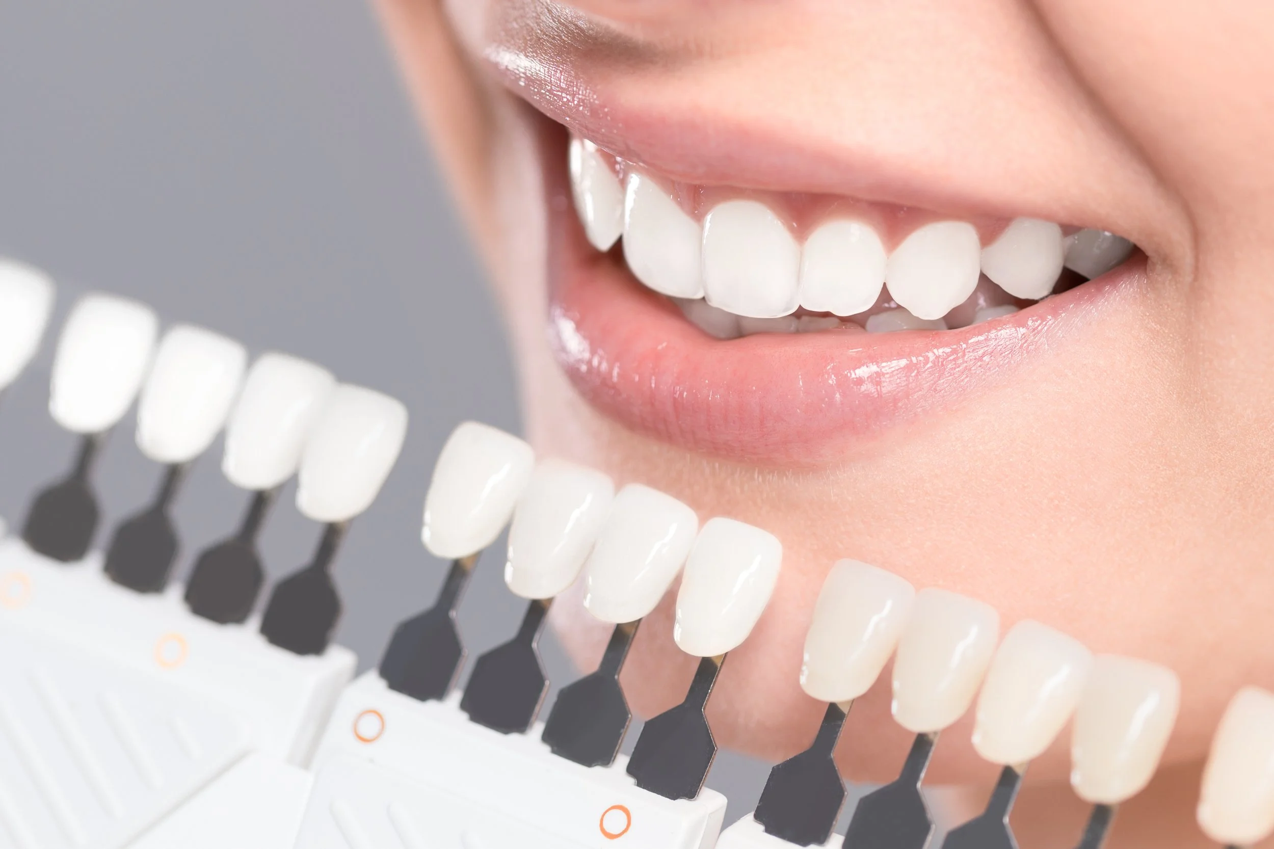 Close-up of a person smiling, showing white teeth, with a shade guide color matching dental veneers or whitening options in the foreground.
