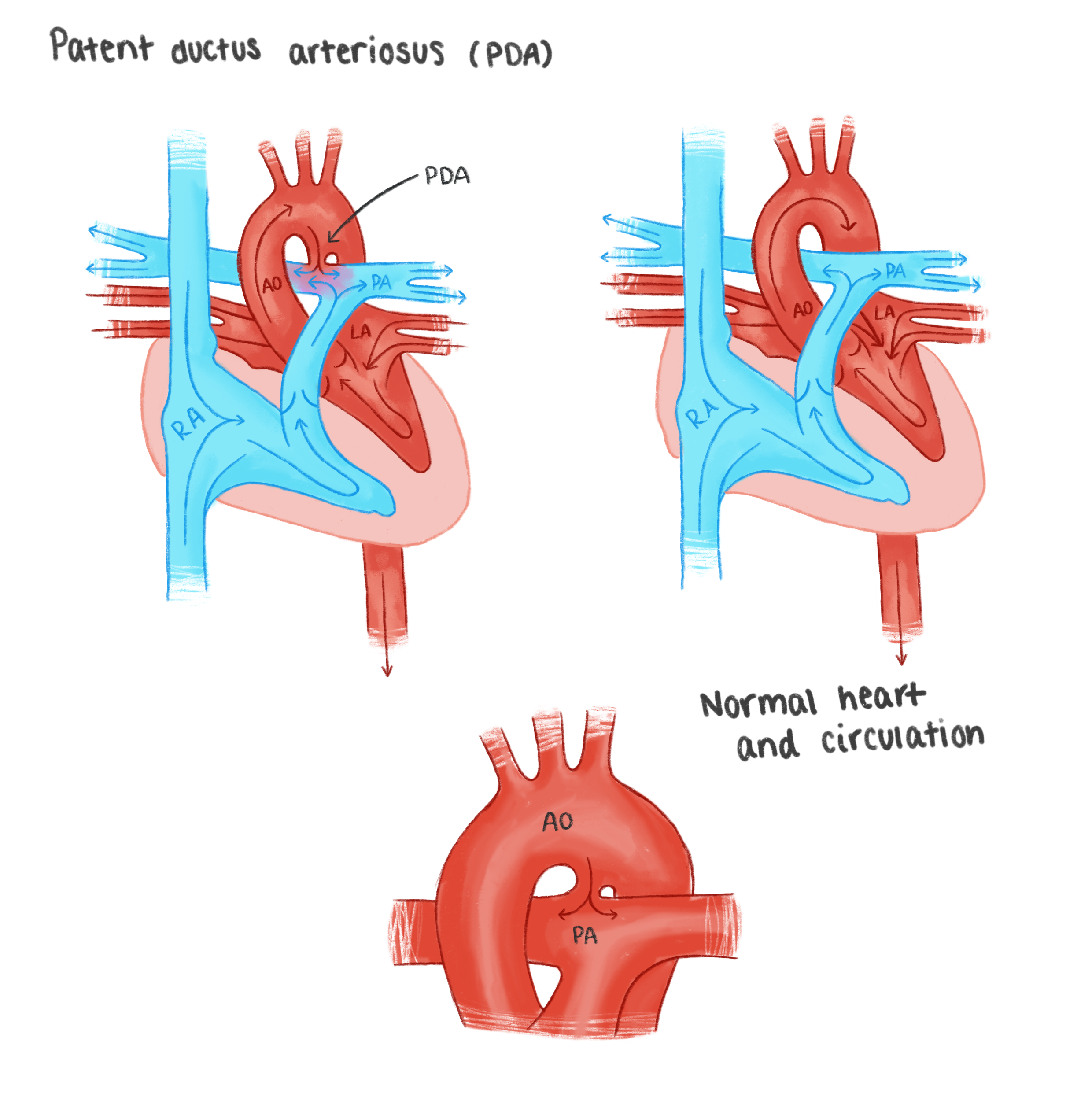 Patent_Ductus_Arteriosus_(PDA).png