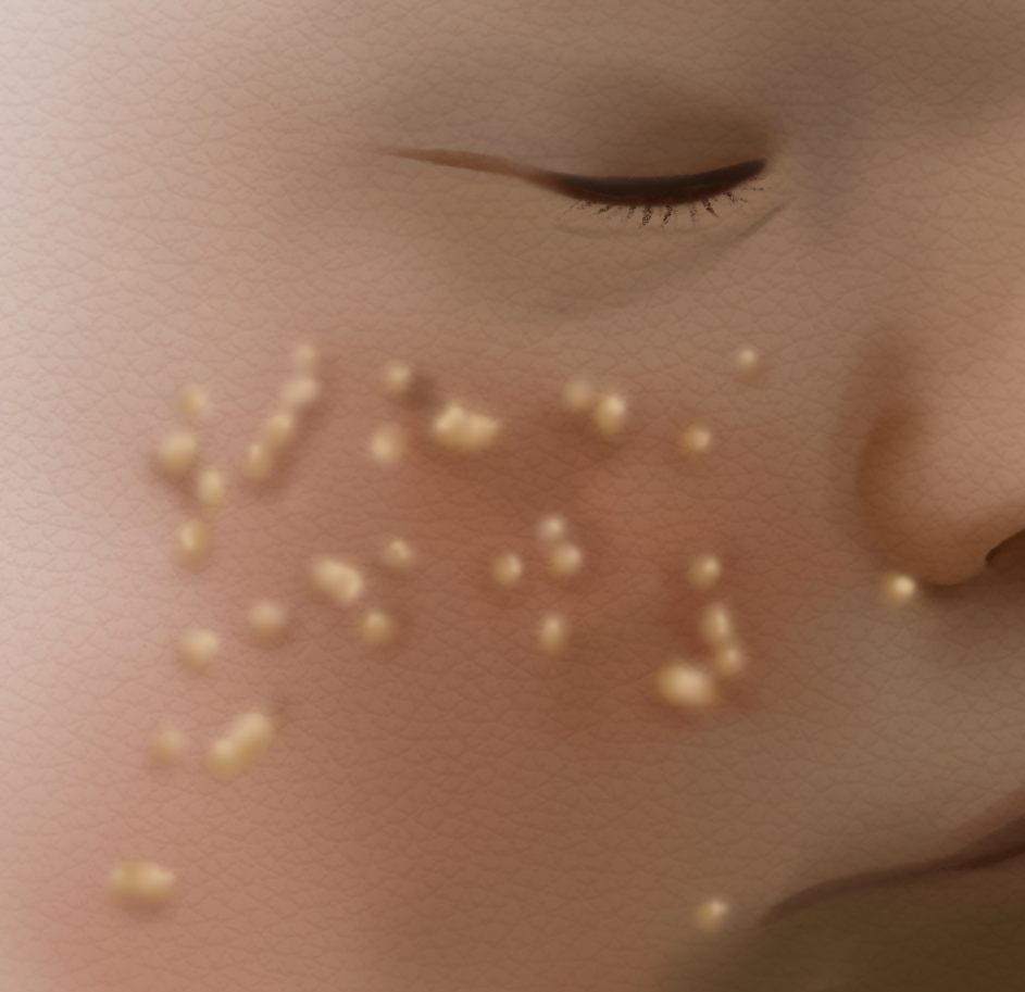 6F.4_Neonatal_Acne.png