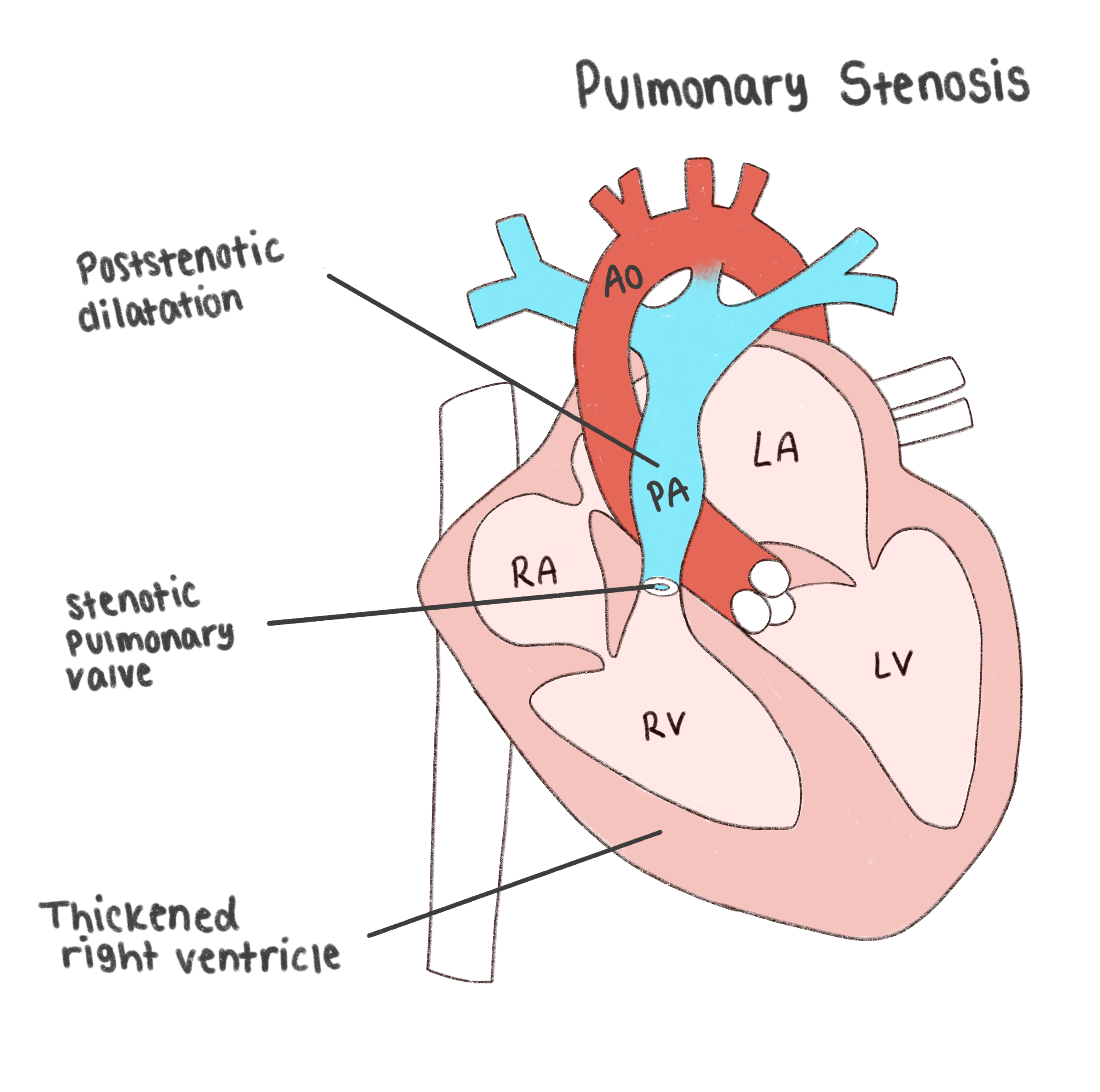 Pulmonary_Stenosis.png
