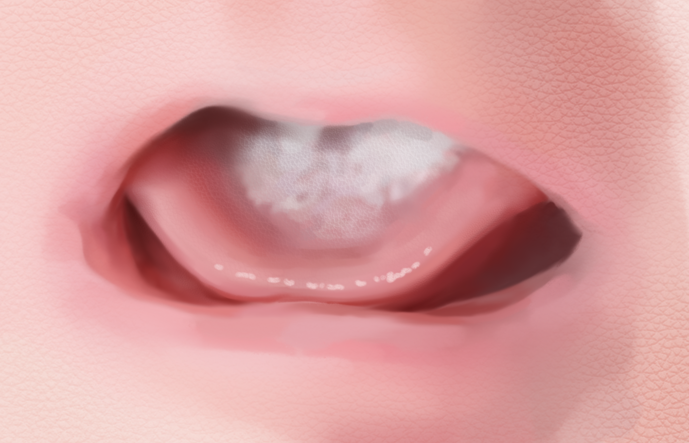 6F.8_Oral_Candida_Infection.png