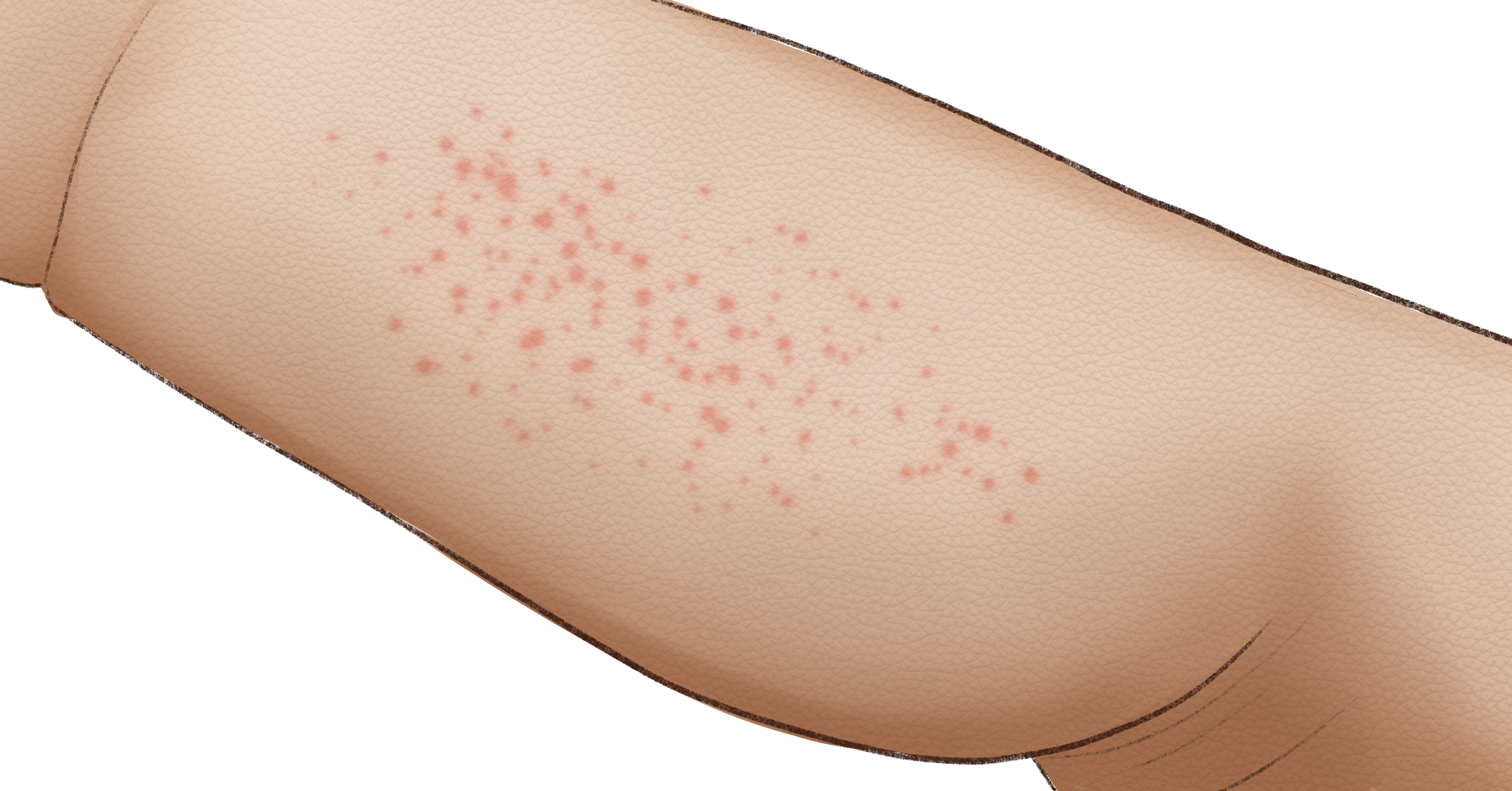 6F.6_Miliaria_.png