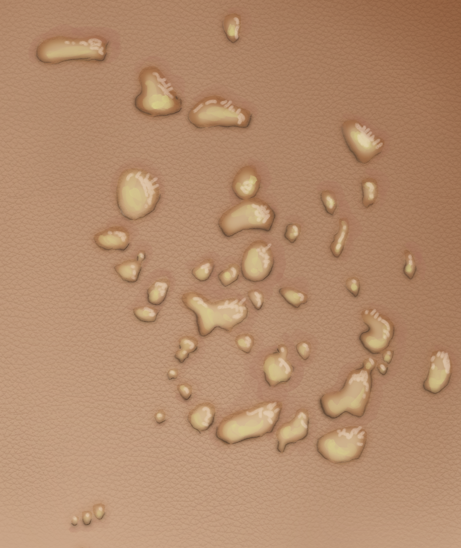 6F.7_Transient_Neonatal_Pustulosis_.png