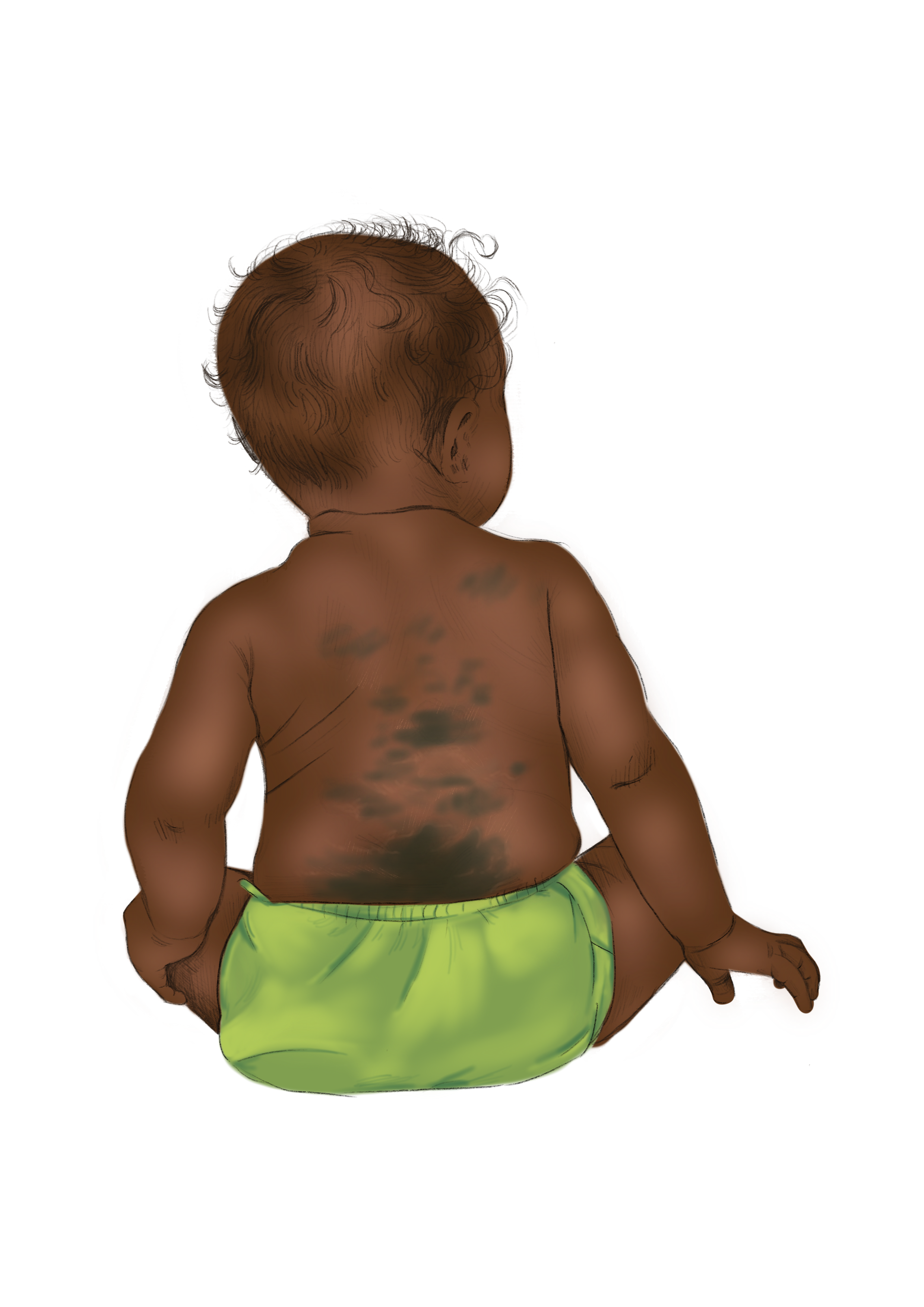 Dermal Melanocytosis.PNG