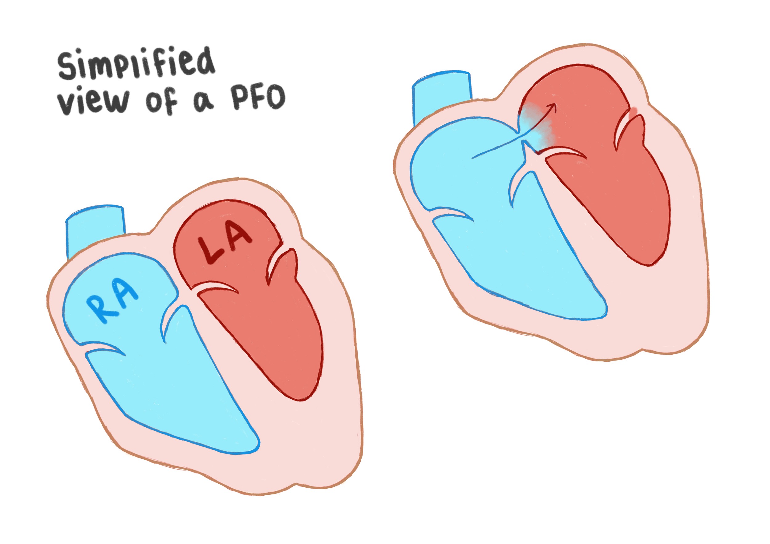 Simplified_PFO.png