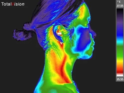 Thermography scan image of a lady's head. Thermography at Wellness Restoration in Jackson, MS, which is used to assess Inflammation and pain, for Circulatory evaluation, and for Preventative health monitoring.