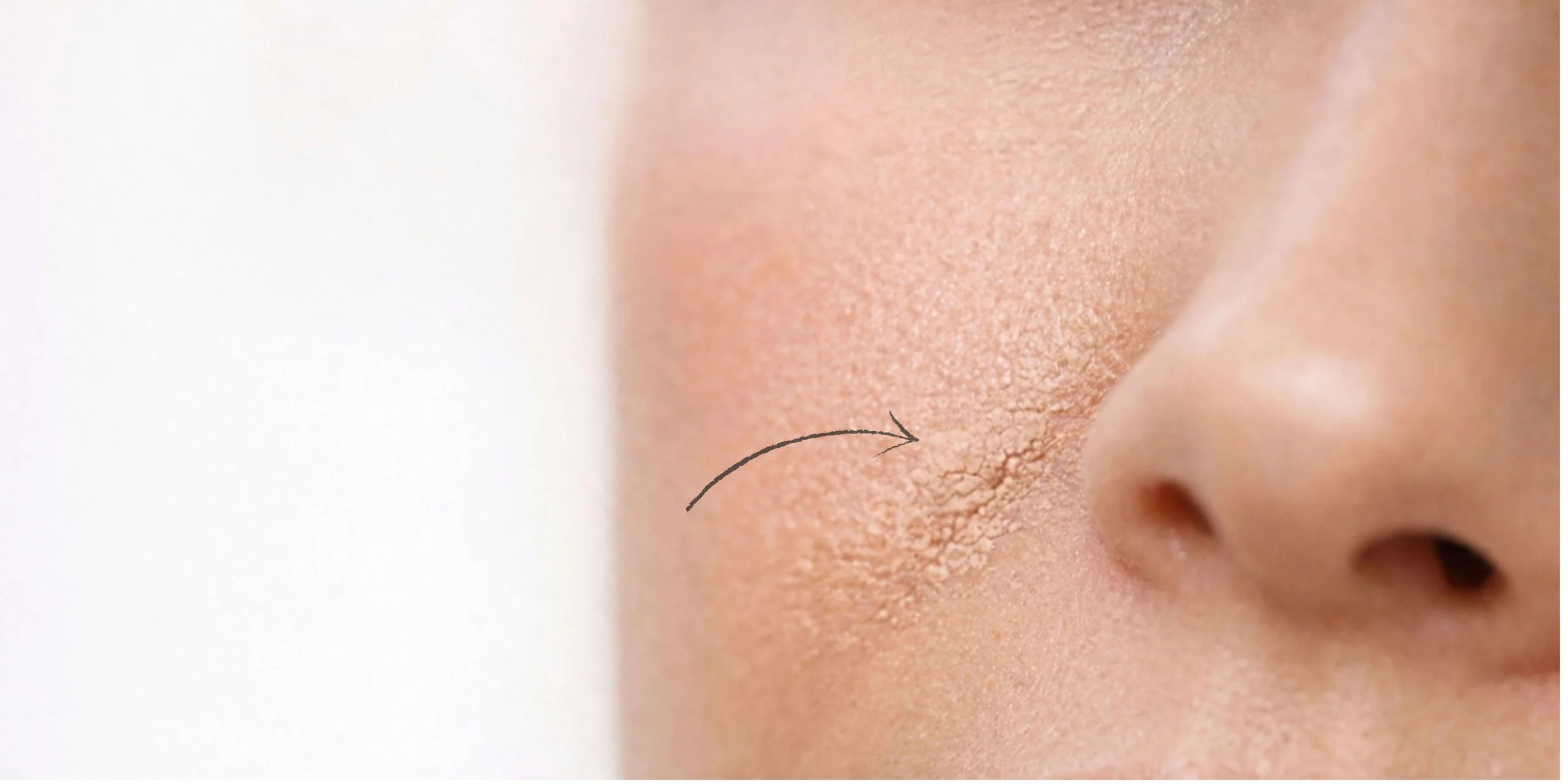 Foundation separating around nose due to product buildup and heavy skin prep