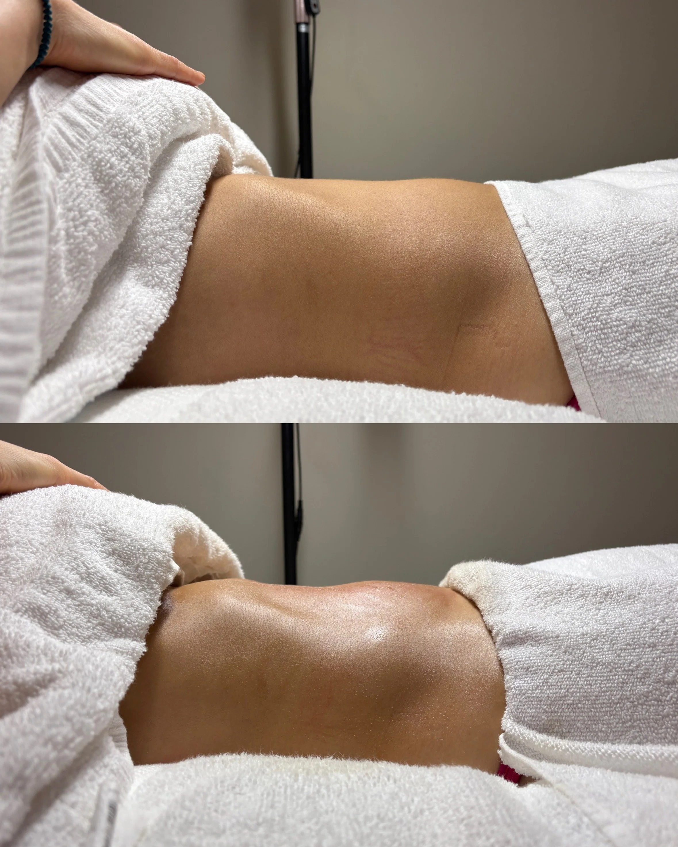Lymphatic Drainage Massage