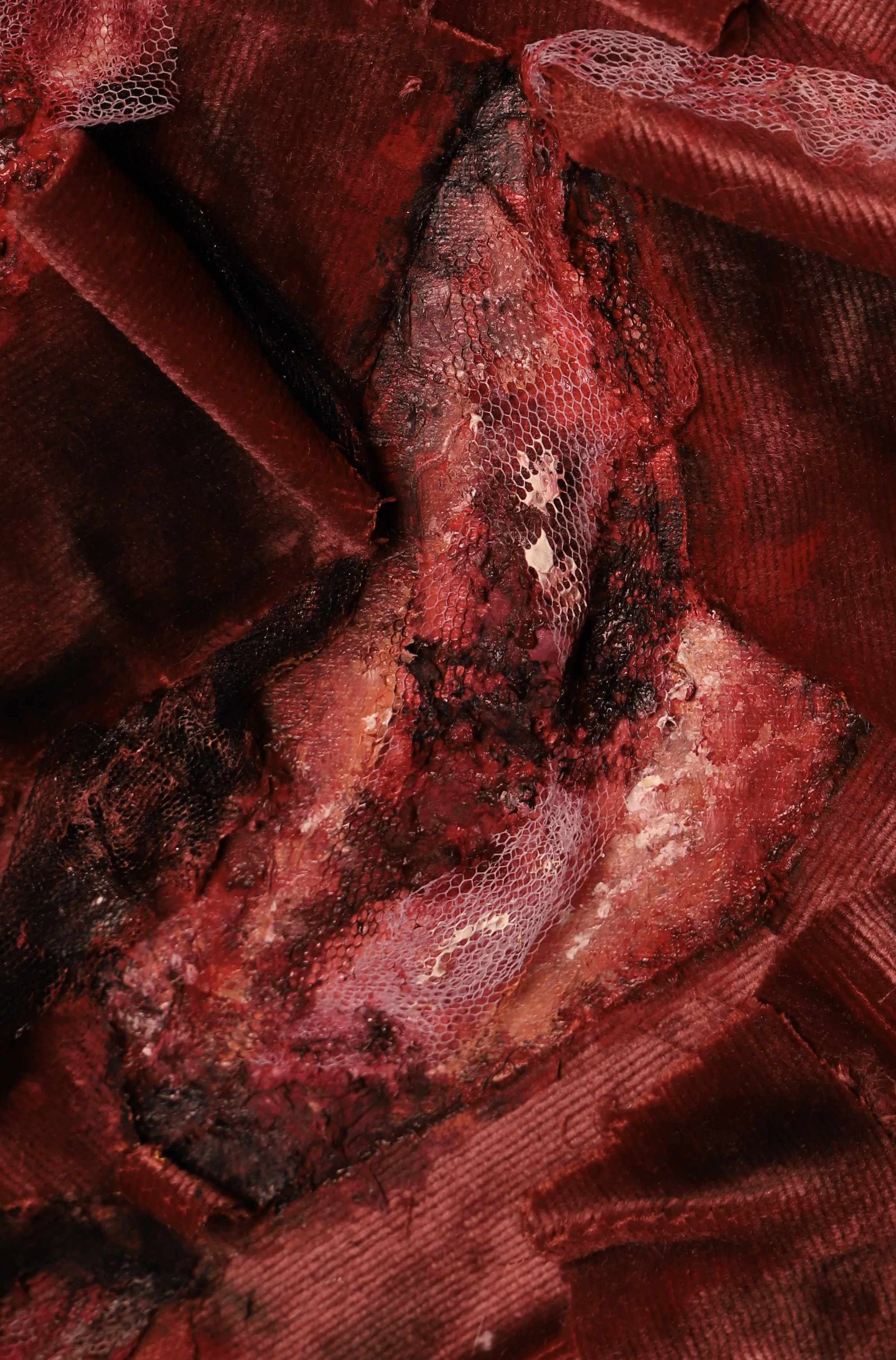 Close-up image of a surgical wound with exposed tissue, colored in red, black, and pink, with some gauze and medical material surrounding the area.