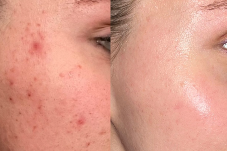 VI Peel Before & After