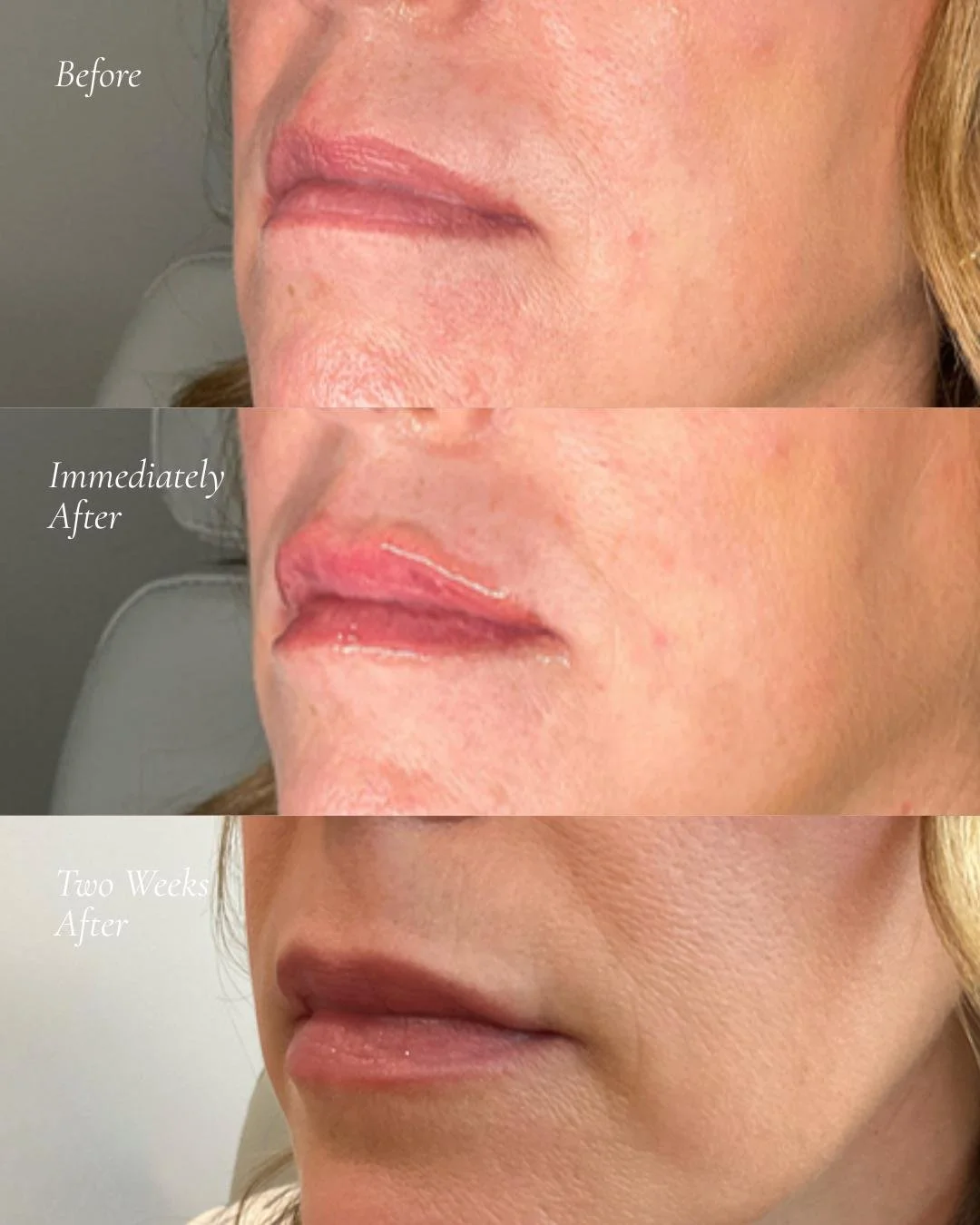 Subtle, soft, and naturally beautiful 💋

Beautifully balanced lips with a subtle enhancement using JUV&Eacute;DERM. Swipe to see before, immediately after, and healed at two weeks.

💉Injector: @taylorstone_fnp 

#LipFiller #NaturalLips #Filler #Juv