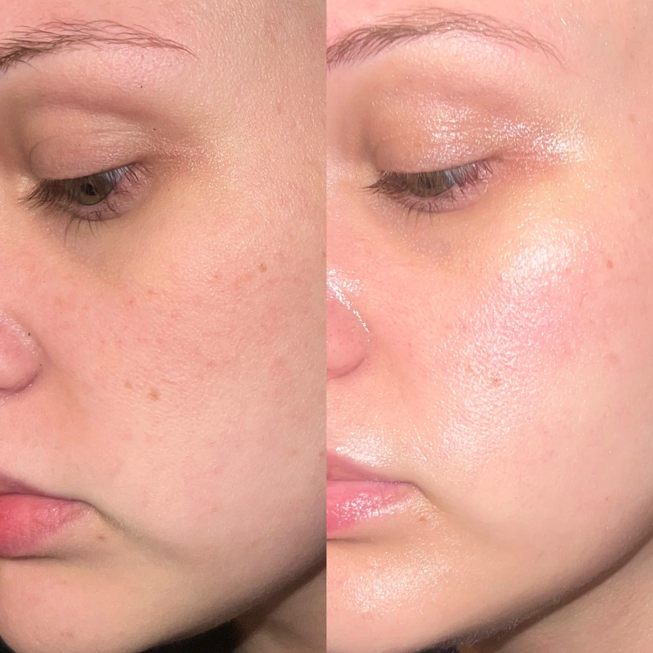 VI Peel Before & After