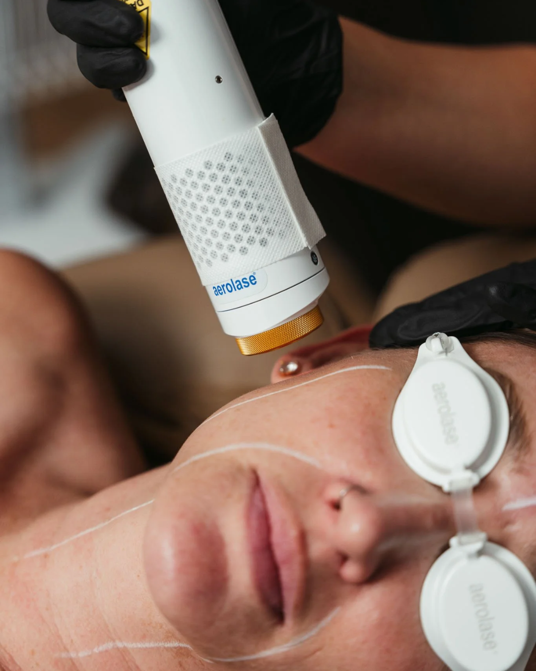 Introducing the Aerolase Elite Neo Laser: Cary, NC's Newest Advanced Skin Treatment
