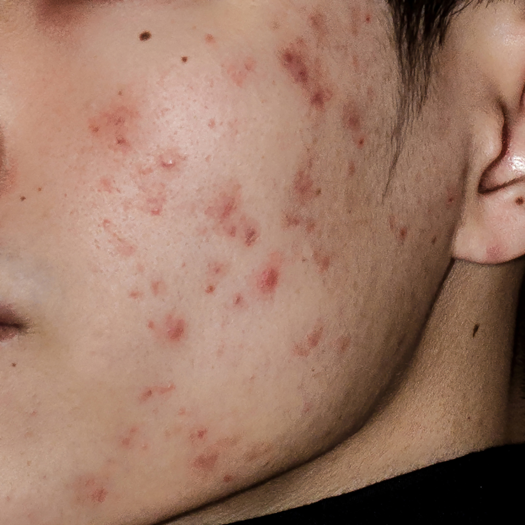 Why Skincare Matters for Teens &amp; Young Adults