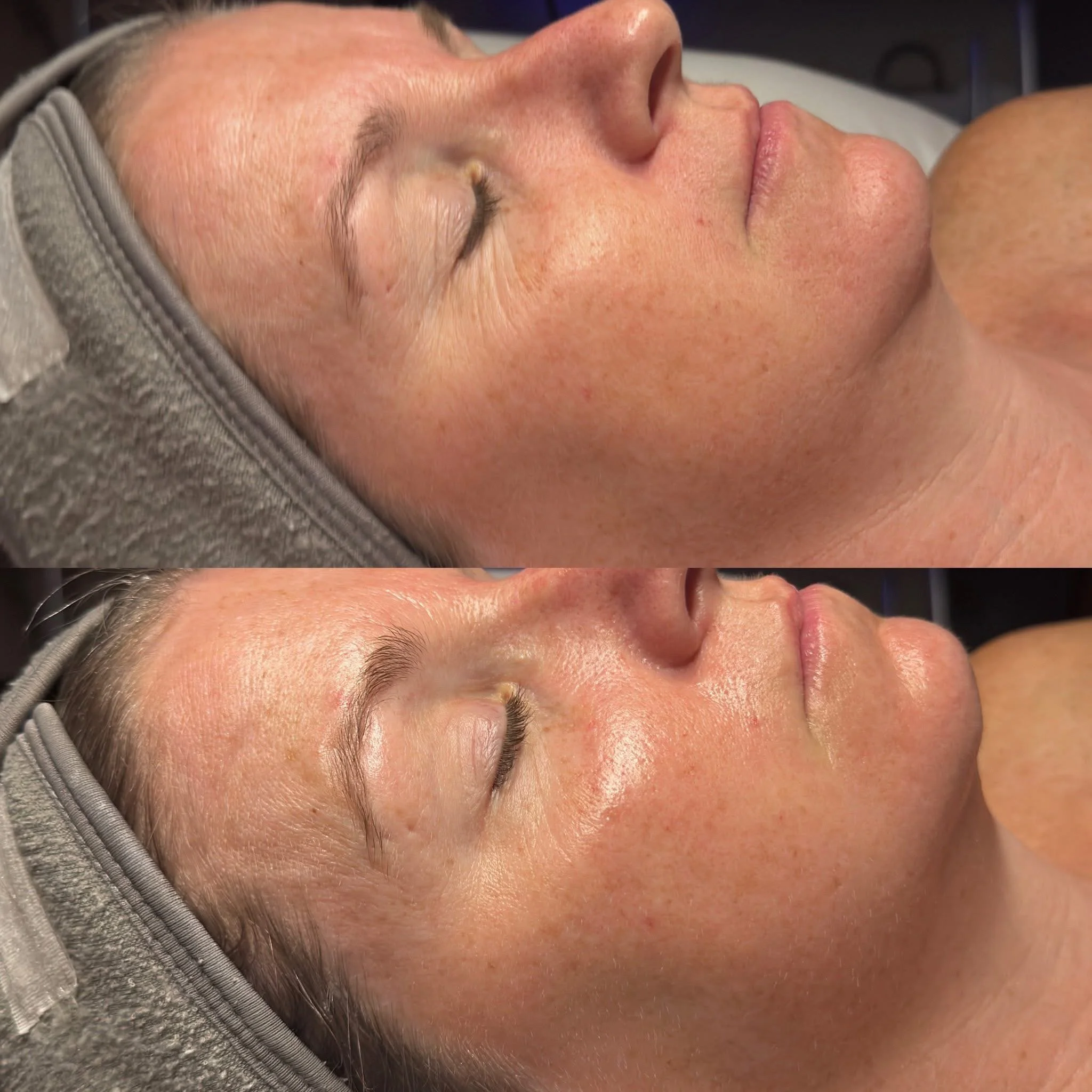 Close-up of a woman with clear skin lying down with eyes closed, appears to have undergone a skin treatment, showing a before and after comparison of facial skin.