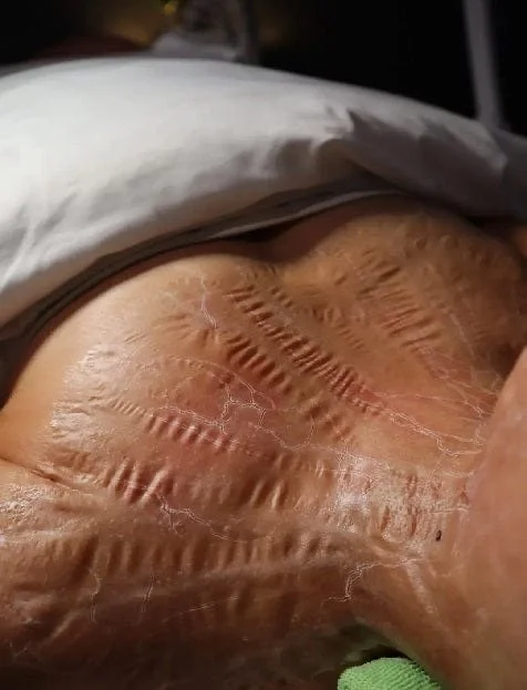 Close-up of a person's heel with deep, jagged cracks and peeling skin, possibly indicating dry or damaged skin.