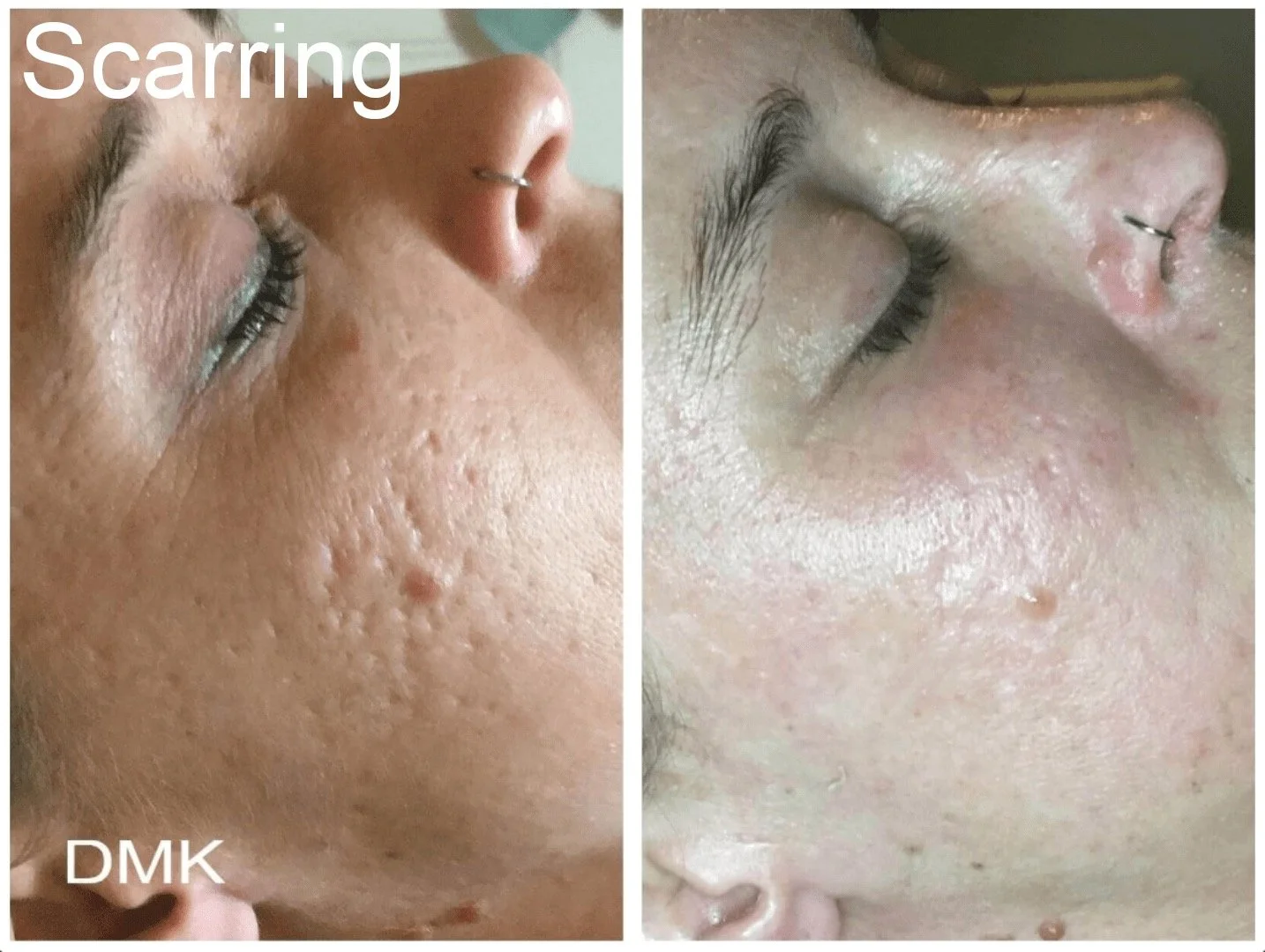 Comparison of skin before and after treatment showing reduced scarring and smoother skin.