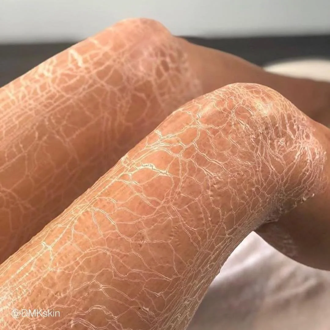 Close-up of dry, cracked skin on a person's fingers.