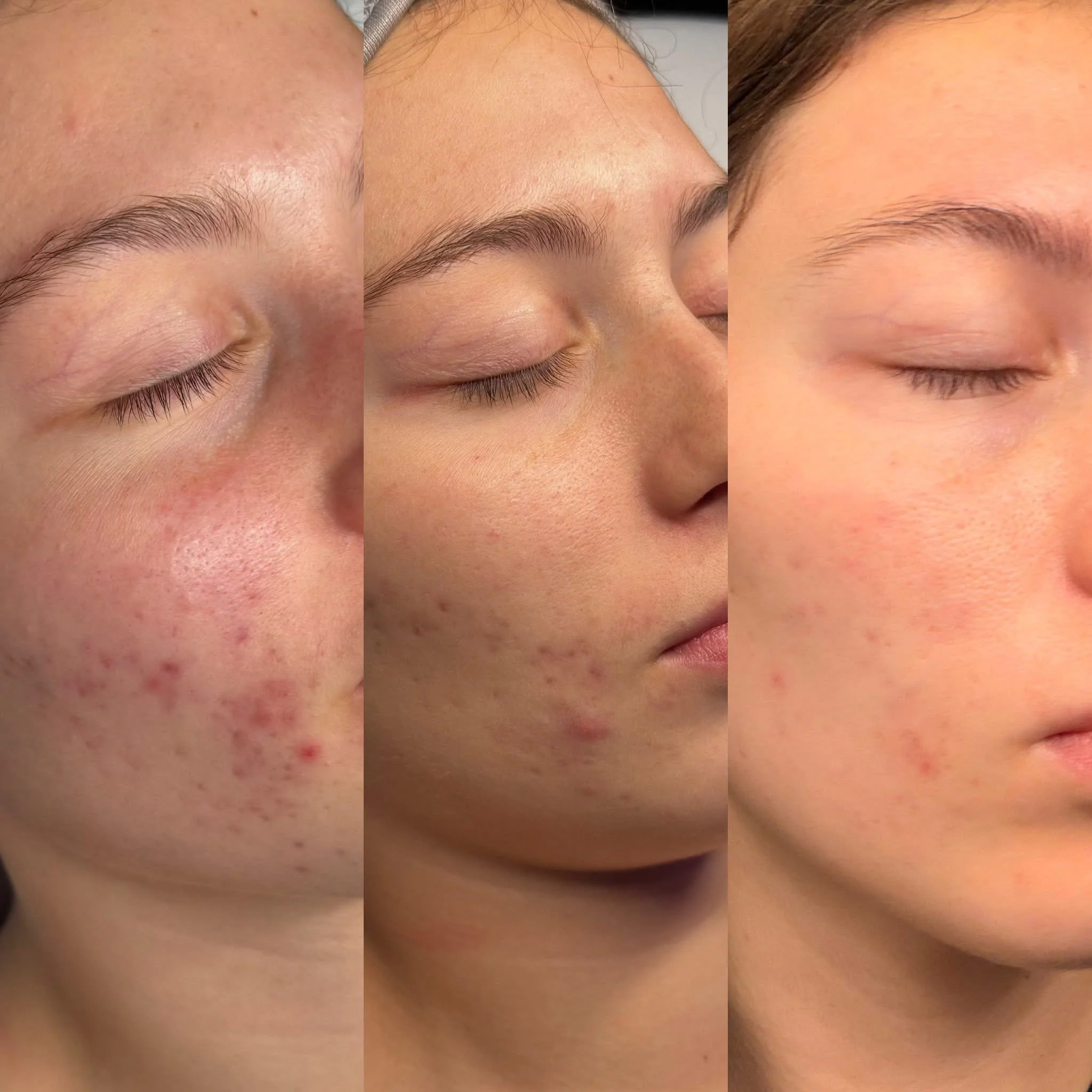 Sequential images showing the improvement of skin from acne and redness to clearer skin.