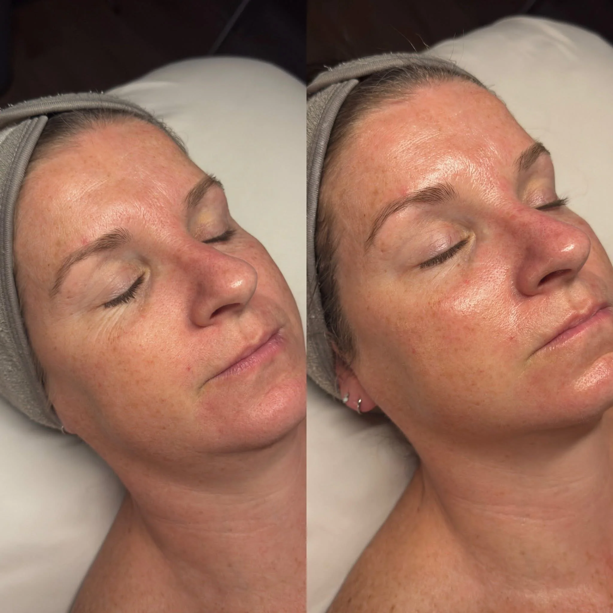 Close-up of a woman with light skin and freckles lying down with her eyes closed before and after a skincare treatment. She has a gray headband and is resting on a white pillow.