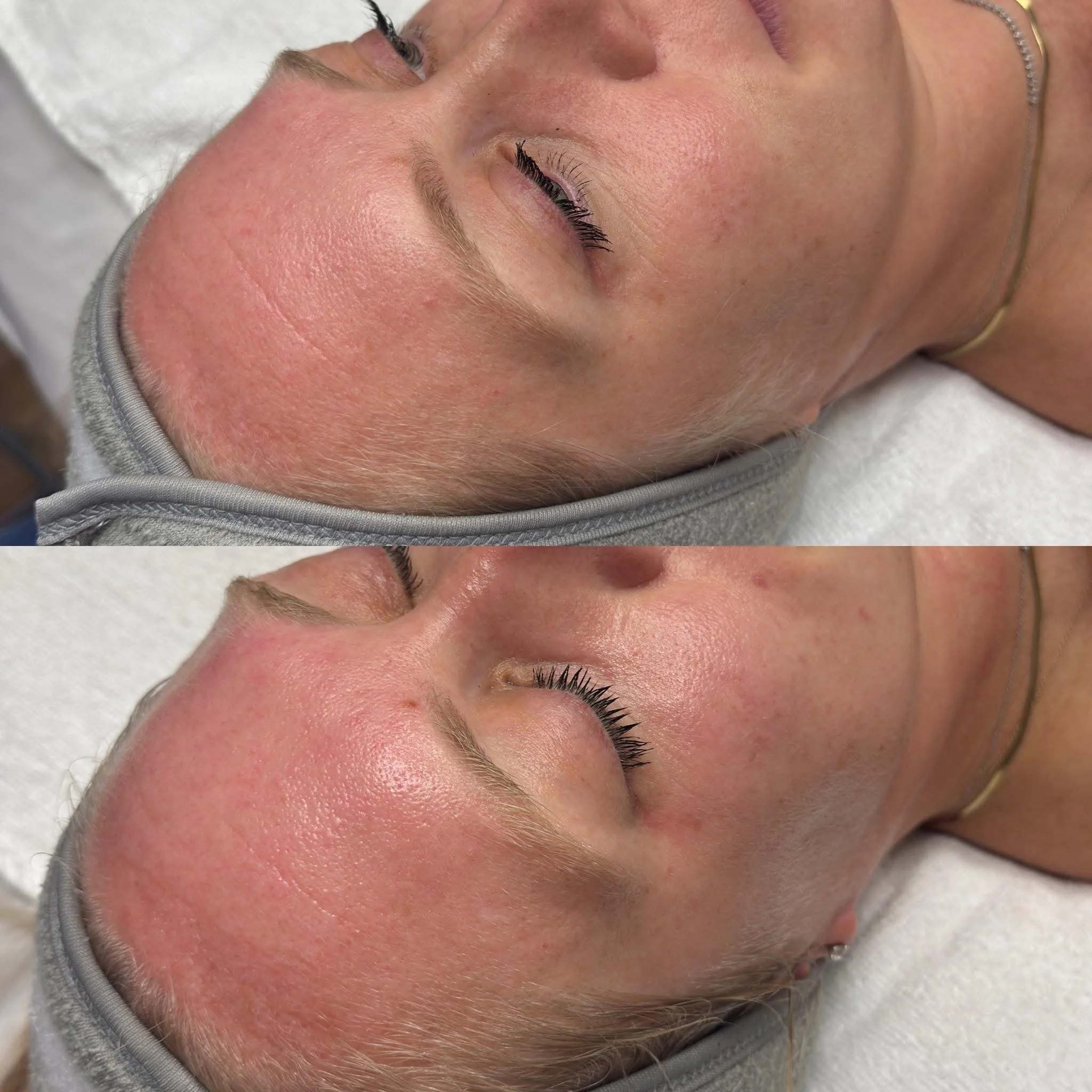 Close-up of a woman's face before and after a cosmetic skincare treatment, showing improved skin texture and reduced redness.
