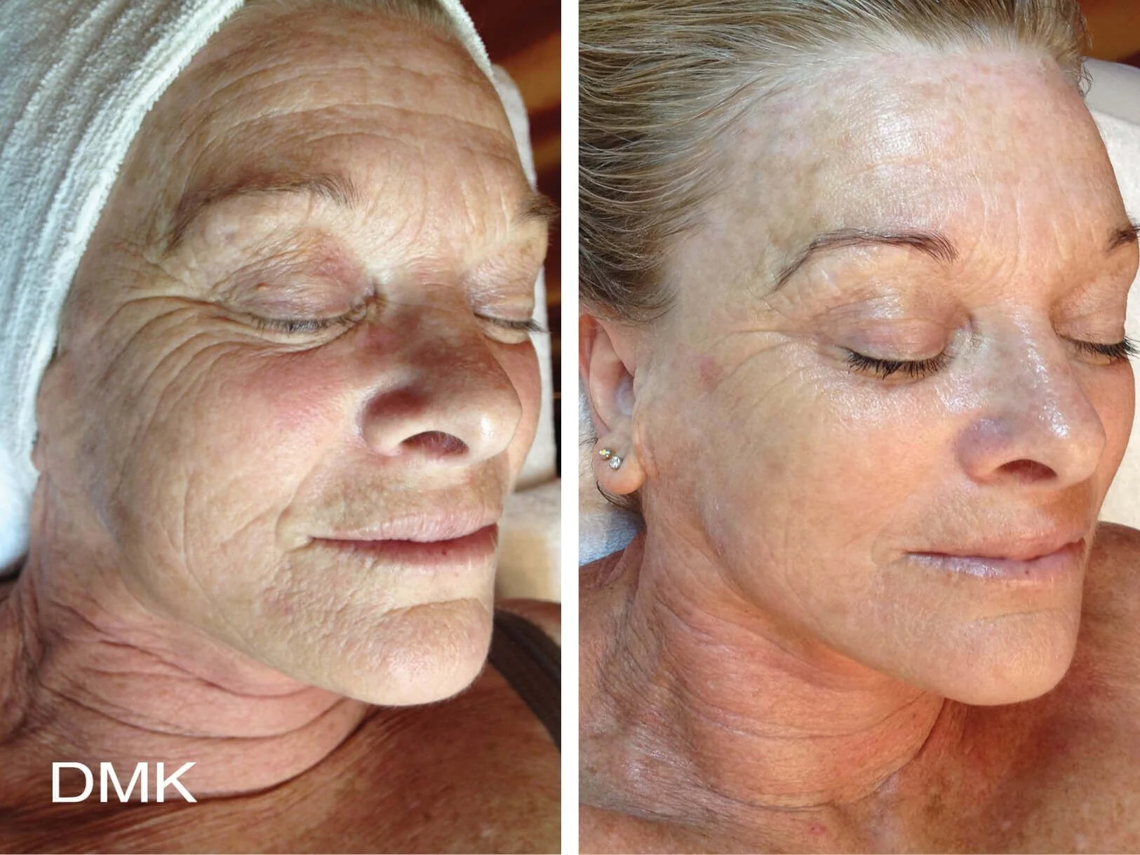 Side-by-side comparison of a woman with aged, wrinkled skin on the left and smoother, rejuvenated skin on the right, showing a skincare or cosmetic treatment result.