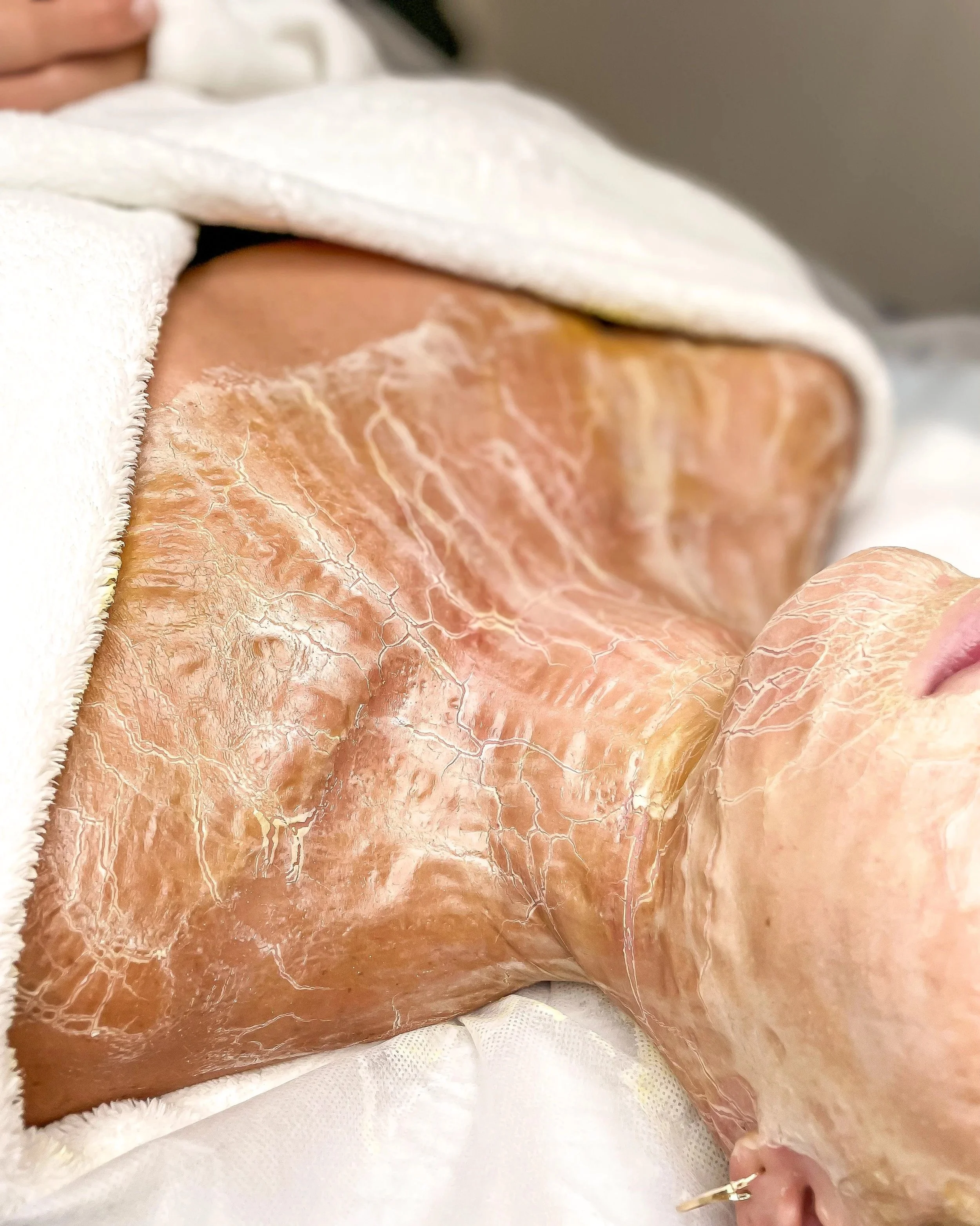 A person lying on a medical examination table with their abdomen exposed. The skin appears very dry and cracked, indicating possible severe skin condition or dermatitis.