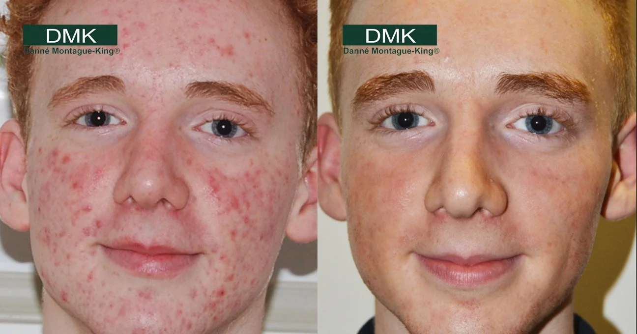 Side-by-side comparison of a young male with severe acne on the left, and clear skin with some minor blemishes on the right.