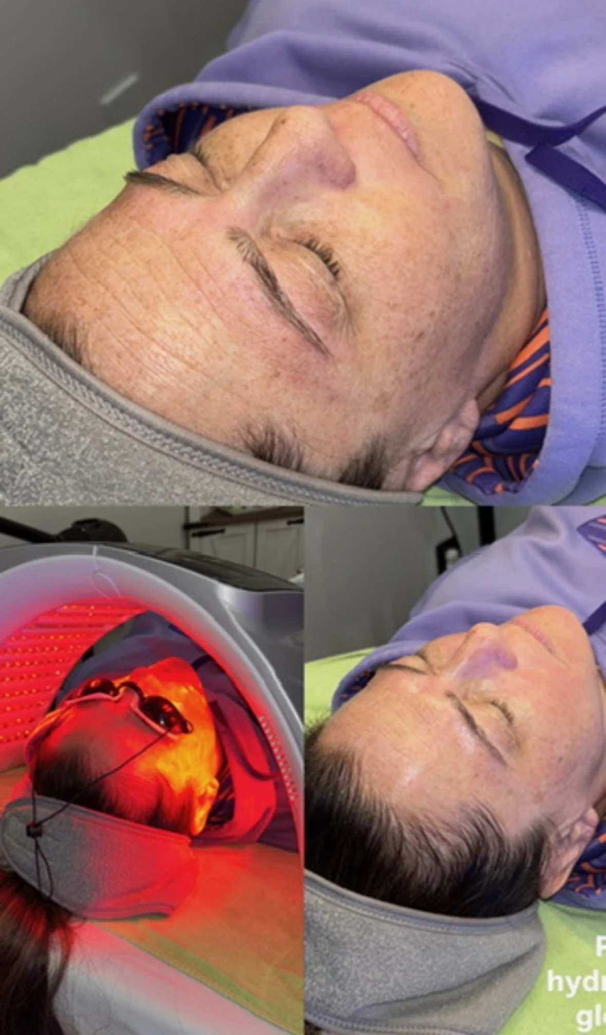 A woman lying down with her eyes closed, undergoing a medical or cosmetic treatment involving a red light therapy device.