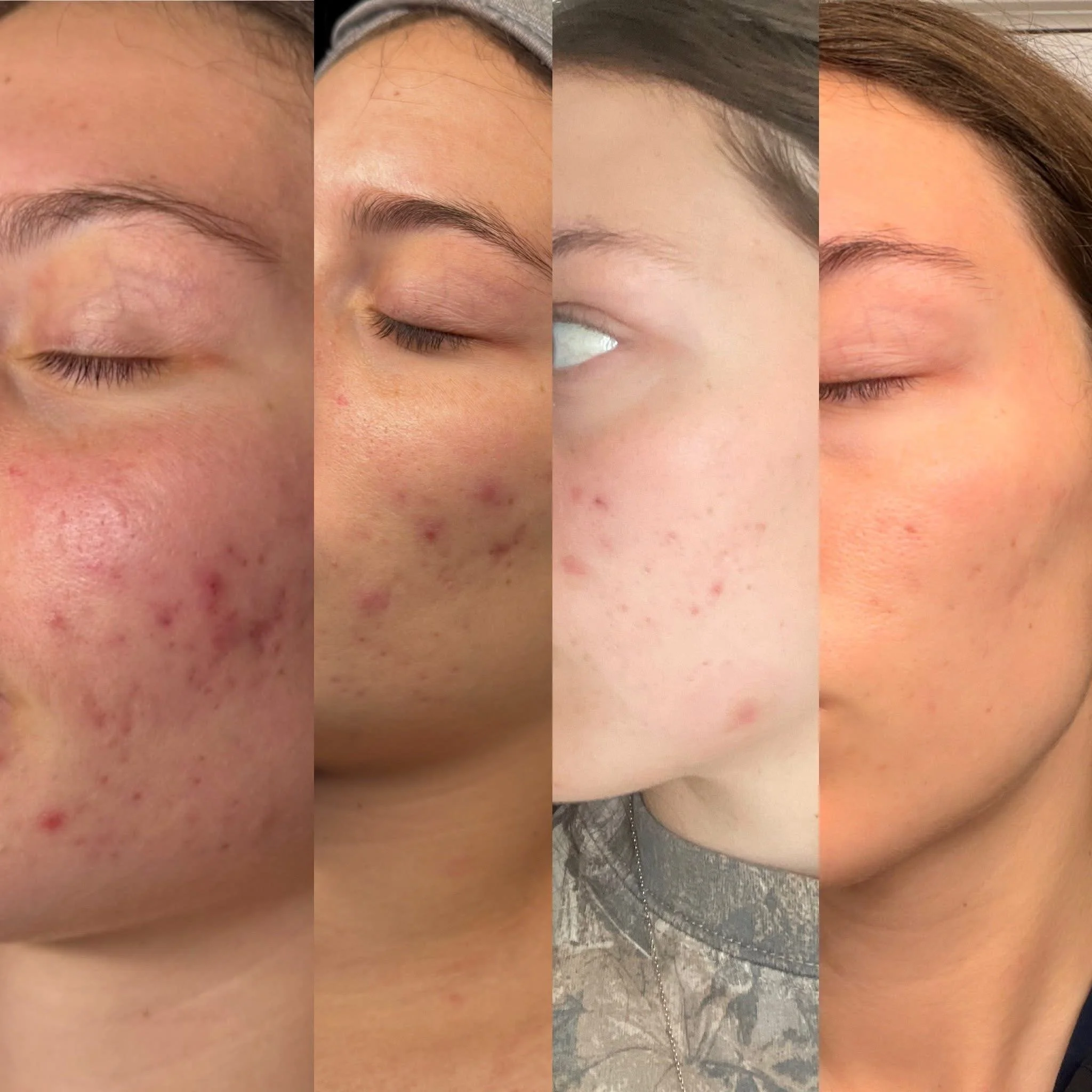Close-up of a woman's face showing a progression of skin improvement from acne and redness to clearer skin.