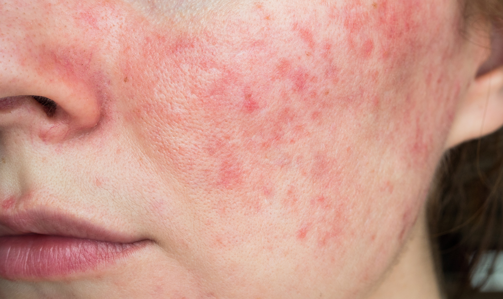 Medspa in Angola, IN, 46703 | Rosacea Near Me