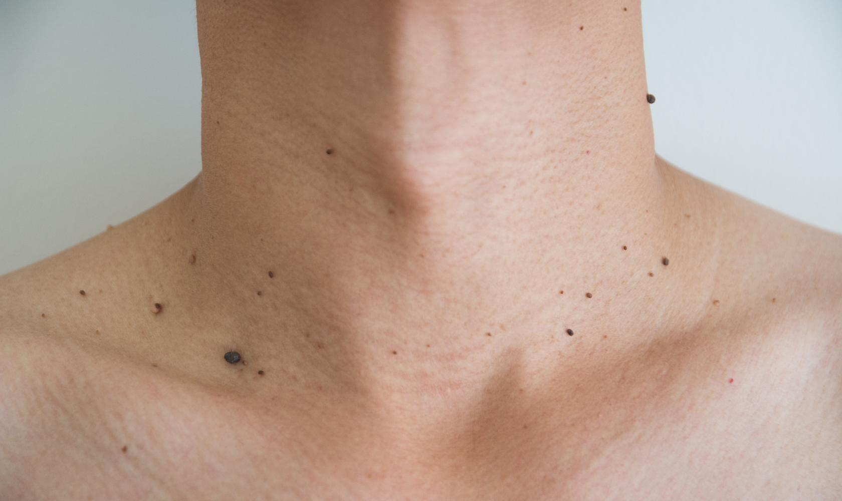 Medspa in Angola, IN, 46703 | Warts Near Me