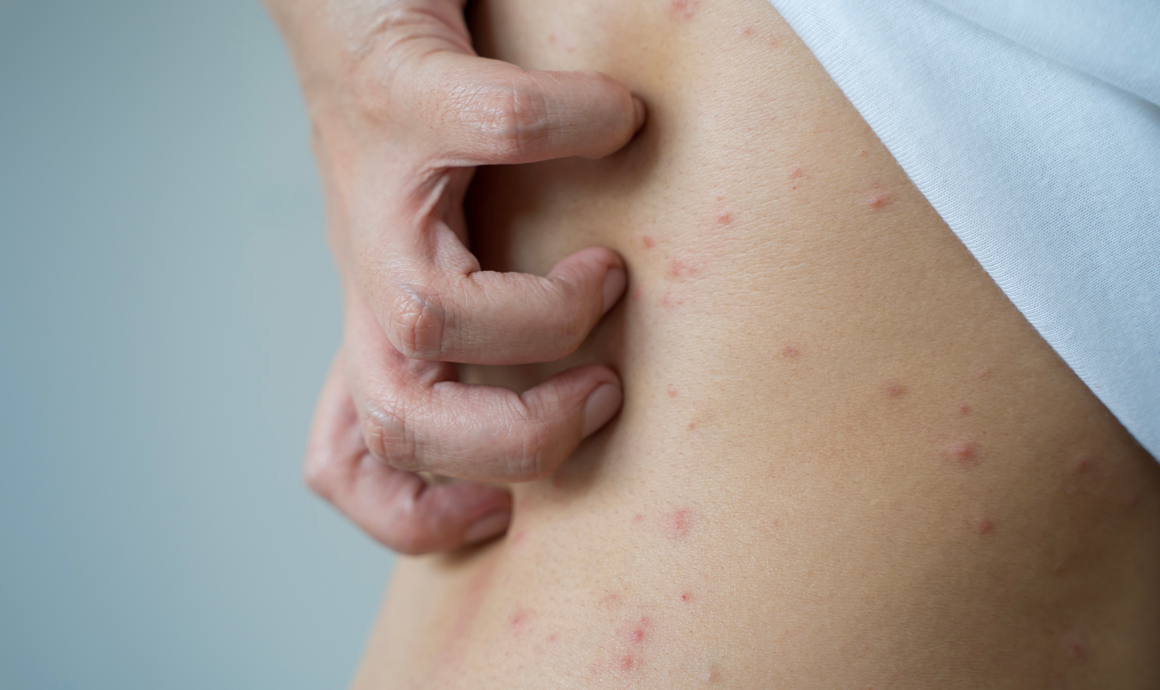 Medspa in Angola, IN, 46703 | Molloscum Near Me