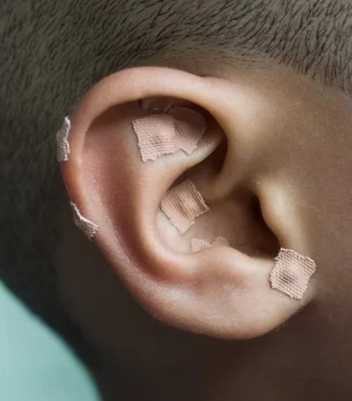 Close-up of a person's ear with multiple adhesive bandages covering parts of the ear.