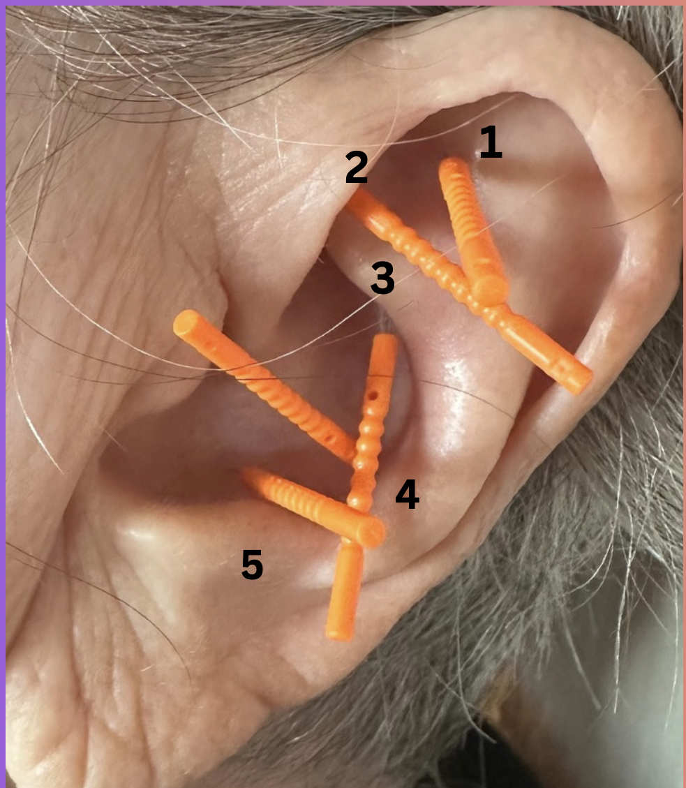 Close-up of an ear with five orange, threaded, flexible ear cleaning tools inserted at different angles, labelled 1 to 5.
